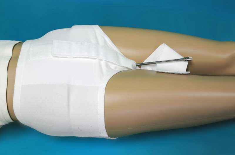 The Radiation Implant Brief securesGYN brachytherapy applicators